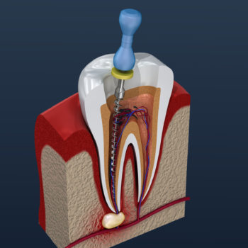dentist mackay ooralea dental root canal procedure