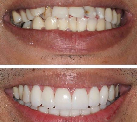 dentist mackay ooralea dental veneers straightening