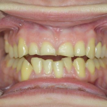 dentist mackay ooralea dental worn down teeth