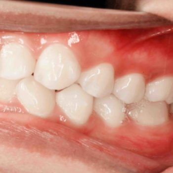 dentist mackay ooralea dental gum disease