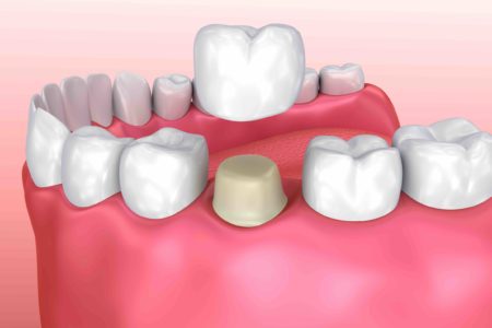 dentist mackay ooralea dental crown