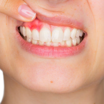 gum disease dentist mackay