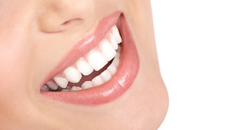 What You Need To Know About Professional Vs At-Home Teeth Whitening