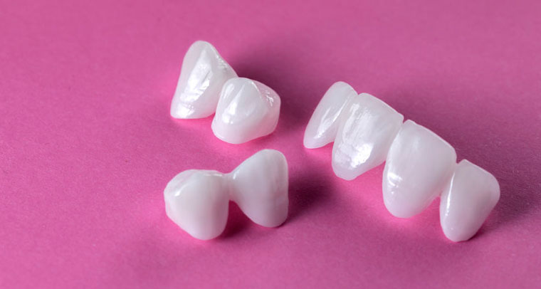 How to decide if dental veneers are suitable for you