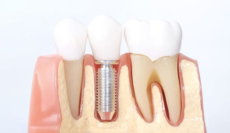 Are You a Good Candidate for Dental Implants?