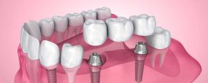 Need Dental Bridges