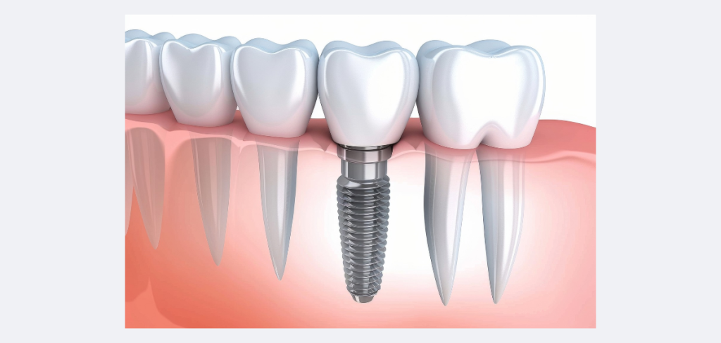 Who Is an Ideal Candidate for Dental Implants?
