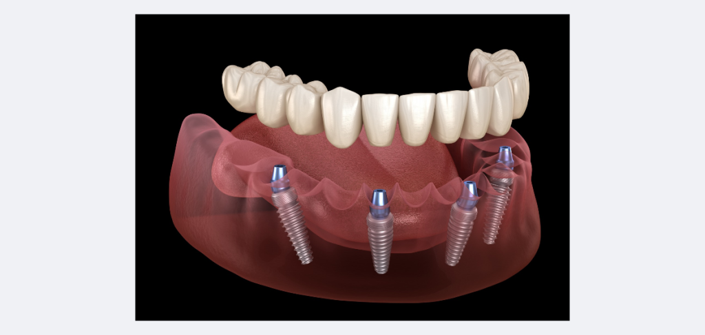 Crown or Prosthesis Fitting