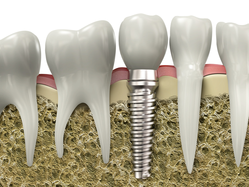 What Are Dental Implants